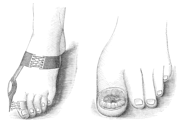 Schwarze und weiße Zeichnung eines Paares Füße, eines mit einem verbundenen Bruch und dem anderen mit einer sichtbaren Fraktur.