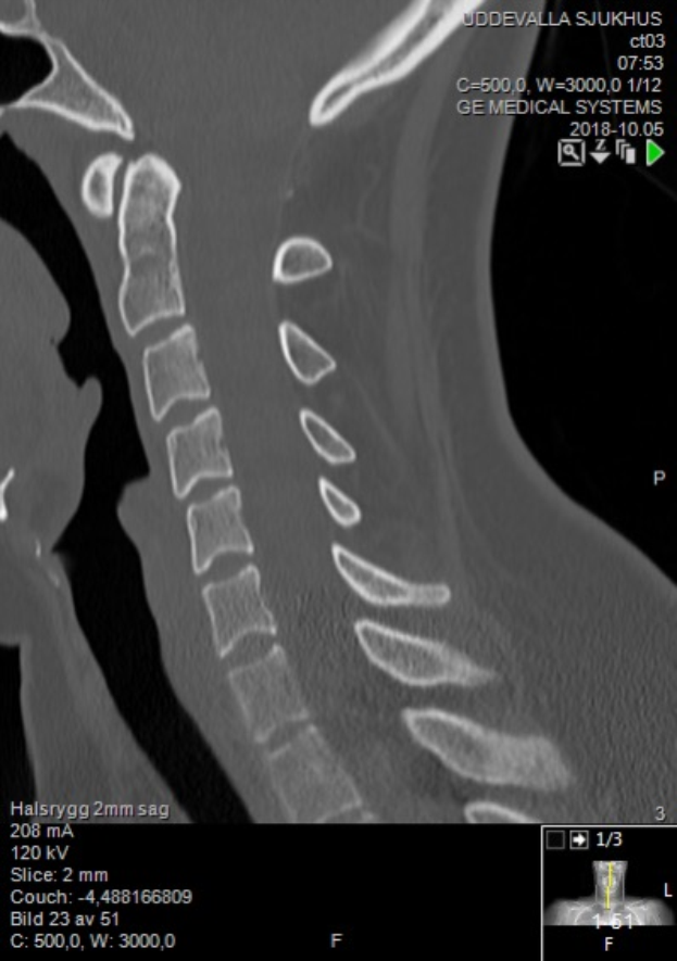 Ein Röntgenbild des Halses eines Mannes mit einer sichtbaren Fraktur in der Mitte, das auf einem Computerbildschirm mit Text und Zahlen angezeigt wird.