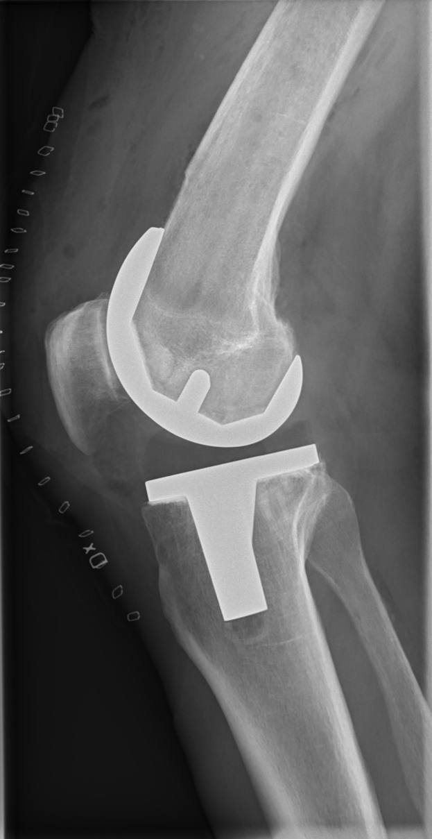 X-ray image of a human leg showing a knee fracture involving a ligament.